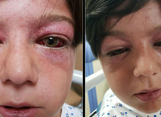Mom has a warning for other parents after playground craze leaves her 11-year-old son “looking like an alien”