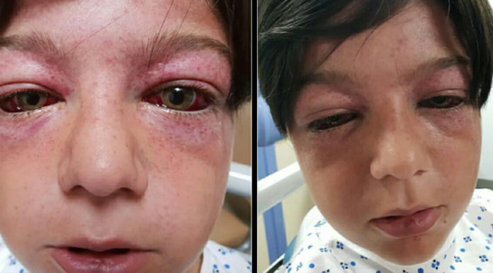 Mom has a warning for other parents after playground craze leaves her 11-year-old son “looking like an alien”