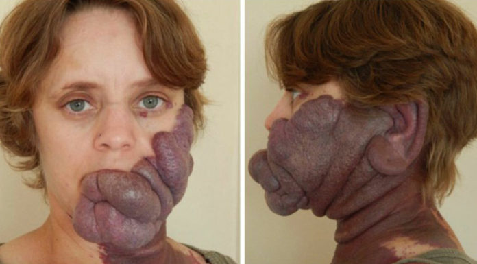 Woman called “Purple People Eater” because of her birthmark undergoes surgery