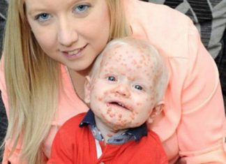 Mom assumes her baby has chickenpox – doctors discover a rare form of cancer