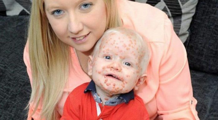 Mom assumes her baby has chickenpox – doctors discover a rare form of cancer