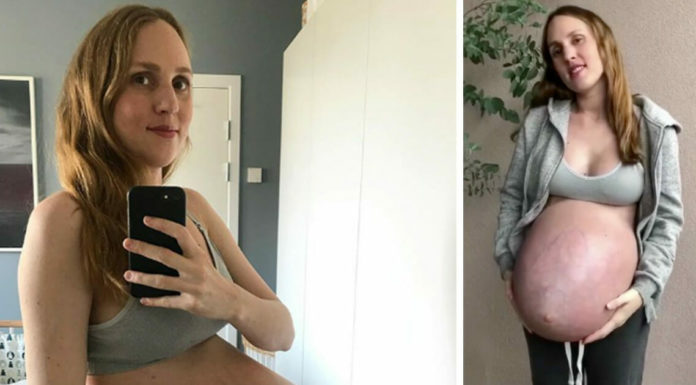 Mom, 36, pregnant with triplets stuns the world with her huge and unusually shaped belly