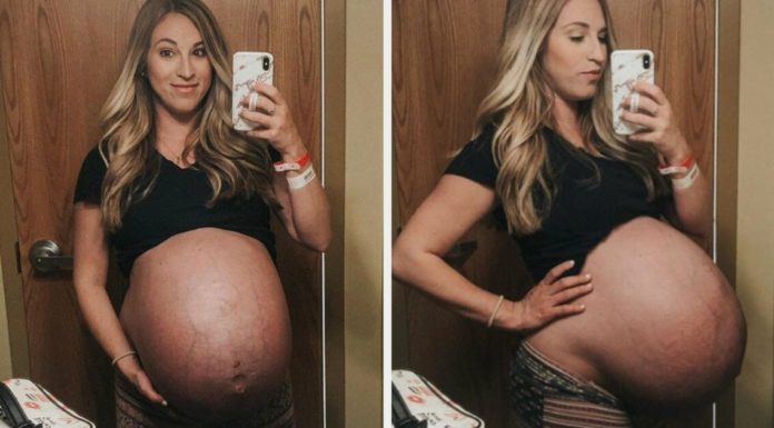 Mom of Quadruplets posts before-and-after photos of her belly to shows how amazing the female body is