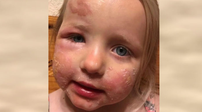 Margarita burns: Mom left in shock after 3-year-old gets severe skin blisters