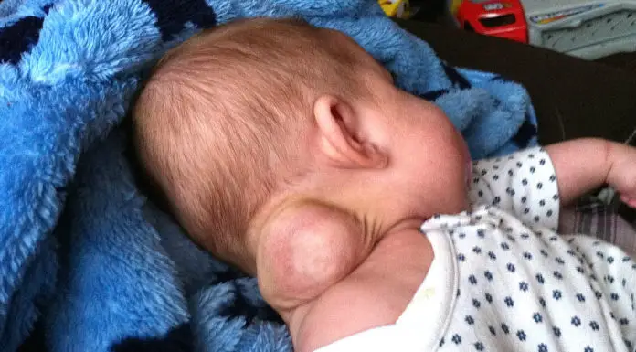 Baby girl born with strange lump on her neck – mom snaps photo as it grows bigger and bigger