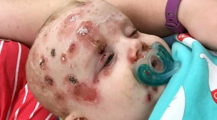 Mom wants to raise awareness of the importance of vaccination by sharing photos of her baby who caught chickenpox