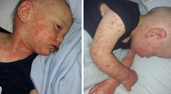 Mom urges parents not to let anyone kiss their babies after her 1-year-old son ended up in hospital with life-threatening rash