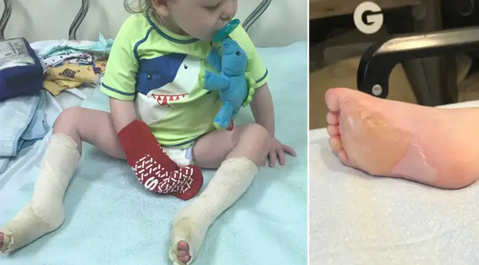 Dad of four is warning parents after his 17-month-old son’s feet “melted” at a splash pad