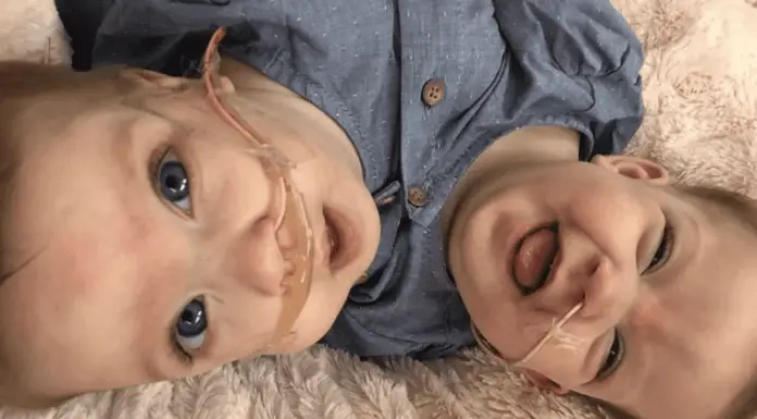 Conjoined twin babies ‘locked in an embrace’ are successfully separated after an 11-hour surgery