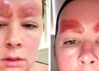 Mom’s skin falls off after microblading procedure goes horribly wrong – she now wants to warn others of possible side effects