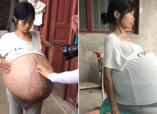 Woman’s belly weights 44 pounds and still growing, doctors fail to learn the reason why