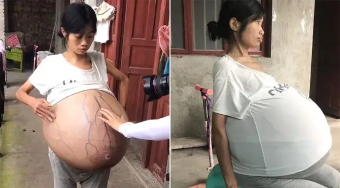 Woman’s belly weights 44 pounds and still growing, doctors fail to learn the reason why