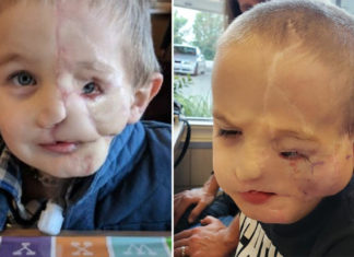 Boy, nearly 7, who lost half his face after being attacked by dogs is called ‘monster’ in public