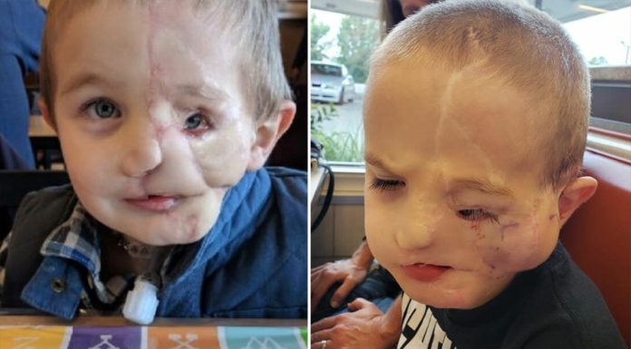 Boy, nearly 7, who lost half his face after being attacked by dogs is called ‘monster’ in public