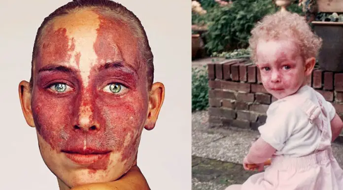 Woman born with birthmark on her face ends up with scars after doctors try to lighten it