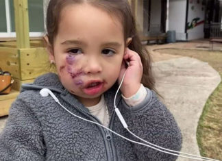 3-year-old girl attacked by a dog wearing service vest while at a restaurant