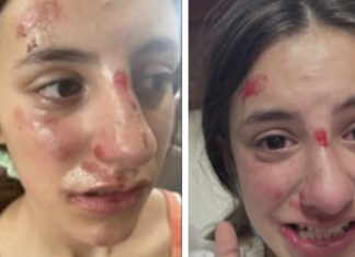 13-year-old girl all covered in bruises after she was beaten and bullied by a classmate during PE class