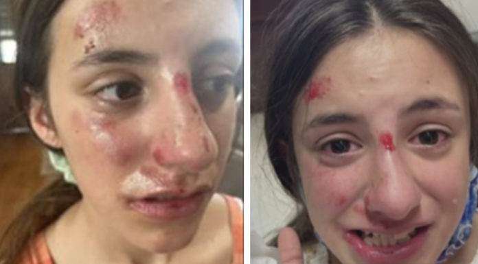 13-year-old girl all covered in bruises after she was beaten and bullied by a classmate during PE class