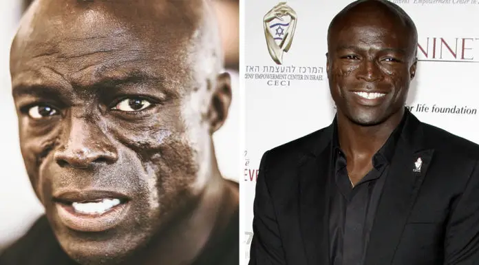 Seal opens up about his facial scars which became his trademark over the years