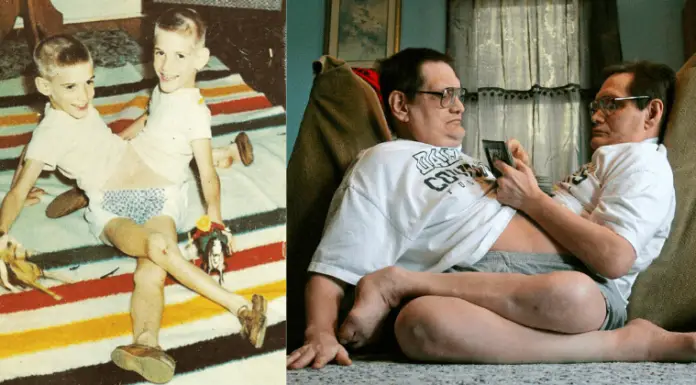 World’s longest surviving conjoined twins, Ronnie and Donnie, die at 68