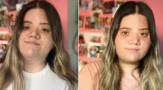 20-yr-old bullied for condition which affects her face takes to social media to address online bullying