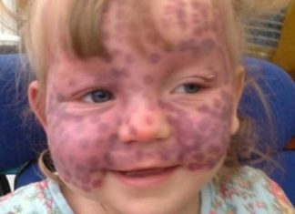 Parents respond to strangers who jump to hurtful conclusions because of their daughter’s rare skin disease