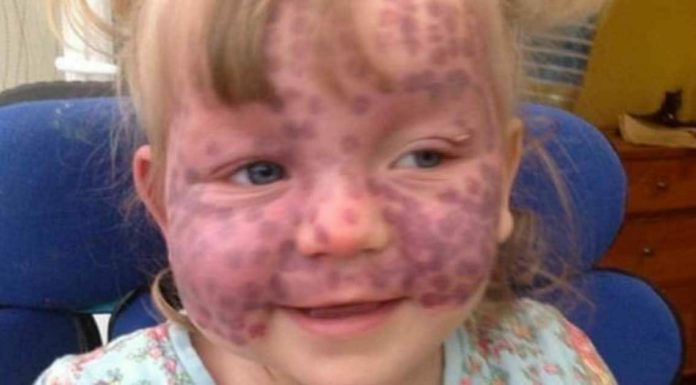 Parents respond to strangers who jump to hurtful conclusions because of their daughter’s rare skin disease