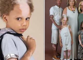 Boy who inherited rare skin condition from his mom lands modeling contract
