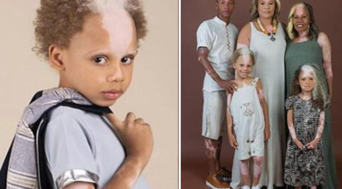 Boy who inherited rare skin condition from his mom lands modeling contract