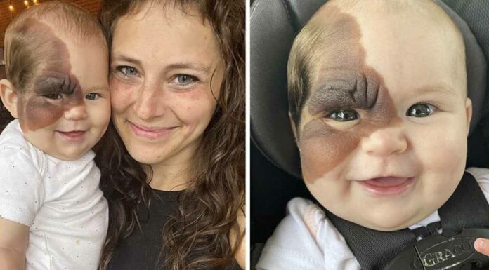 Mom on a mission to show daughter with extremely rare birthmark that she is beautiful