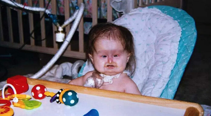 Mom notices something’s wrong when giving birth – 25 years later her daughter is still mistaken for a child