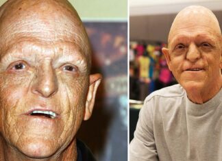 He became an actor despite his rare congenital disability – now he’s an inspiration for millions