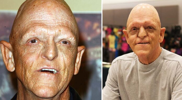 He became an actor despite his rare congenital disability – now he’s an inspiration for millions