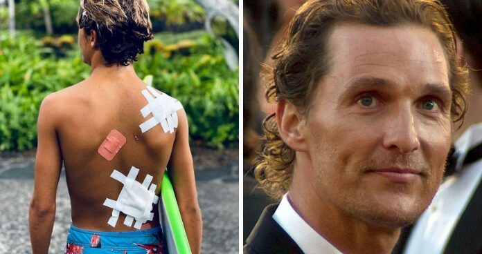 Matthew McConaughey displays his son’s serious surf injuries as ‘souvenirs’