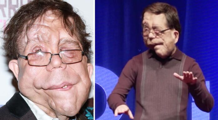 The inspiring journey of Adam Pearson: The actor with a genetic condition who refused to be defined by it