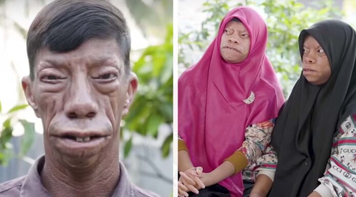 Family with mysterious facial condition are becoming an internet sensation – now they’re inspiring millions worldwide