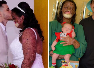 Woman with rare skin condition overcomes negativity and finds true love