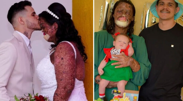 Woman with rare skin condition overcomes negativity and finds true love