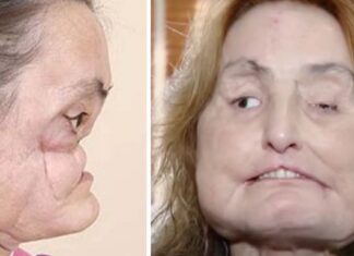 Connie Culp became the first-ever face transplant patient in the US: Inside her remarkable story