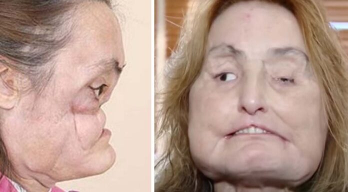 Connie Culp became the first-ever face transplant patient in the US: Inside her remarkable story