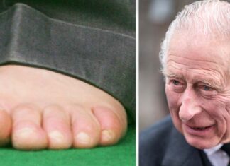 King Charles’ sausage toes could suggest ‘systemic condition,’ expert claims