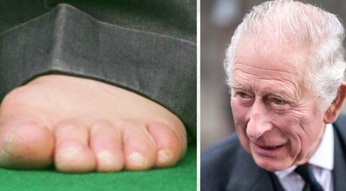 King Charles’ sausage toes could suggest ‘systemic condition,’ expert claims
