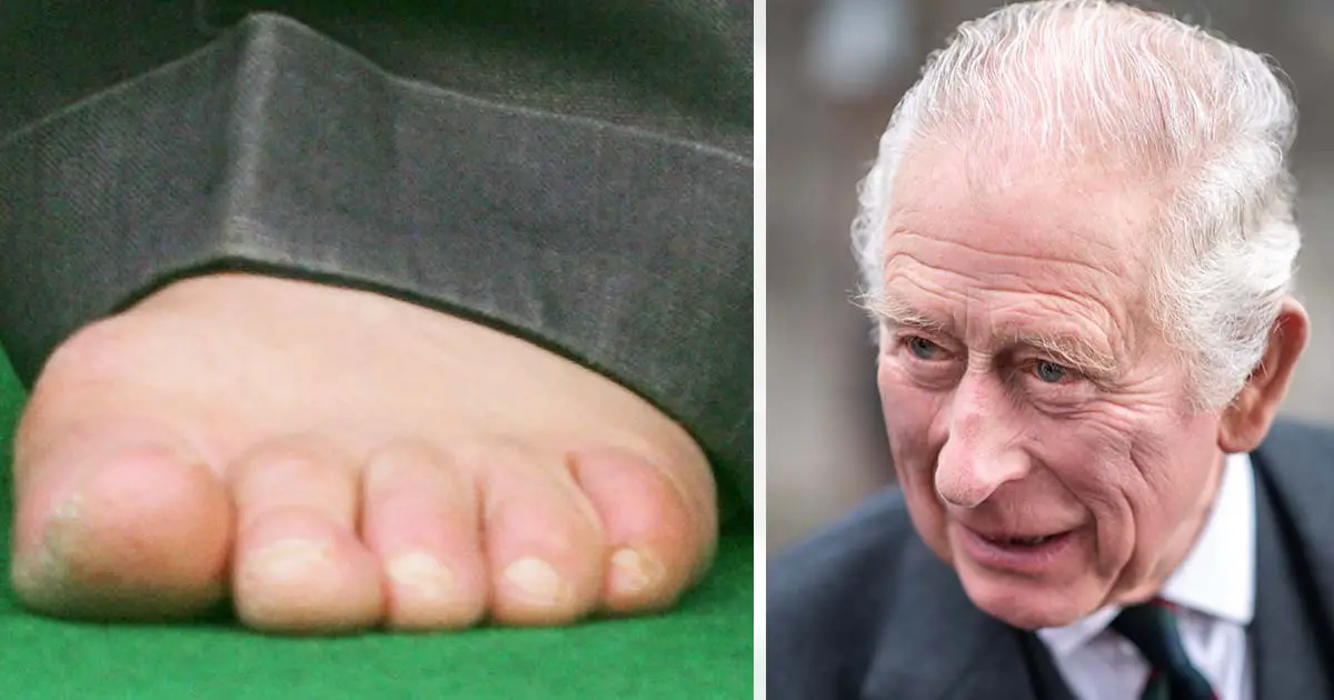 King Charles' sausage toes could suggest 'systemic condition,' expert