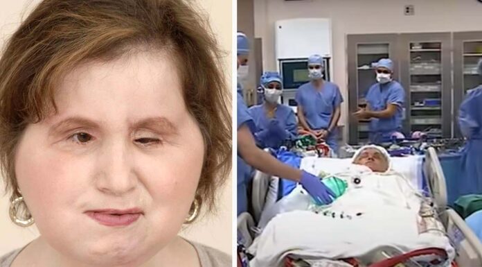 The amazing story of Katie Stubblefield: She became the youngest person to receive a face transplant