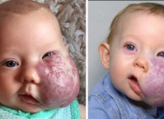 The incredible story of Sloan McGillis: She was born with a giant facial tumor – but overcame all obstacles