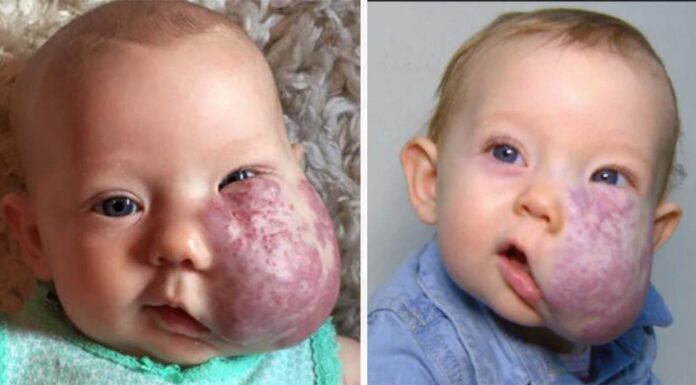 The incredible story of Sloan McGillis: She was born with a giant facial tumor – but overcame all obstacles