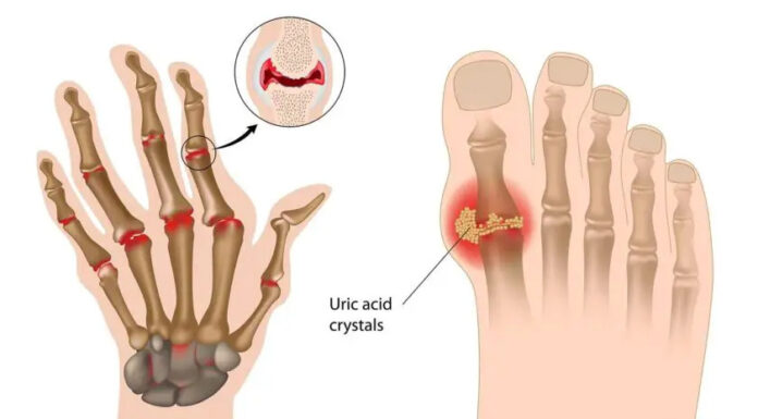 How to Remove Uric Acid Crystallization in Joints Fast (This Causes Gout AND Joint Pain)