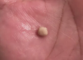 Here’s what you need to know about tonsil stones – the weird pimple-like growths in your throat