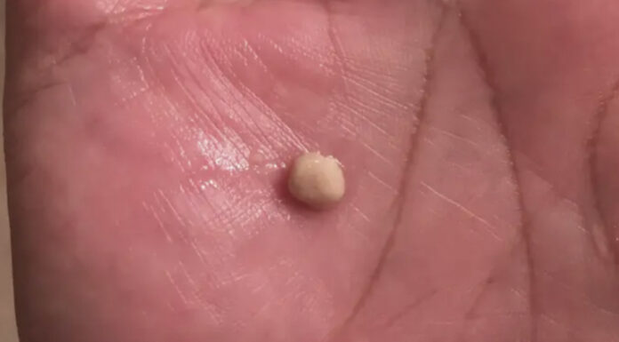 Here’s what you need to know about tonsil stones – the weird pimple-like growths in your throat