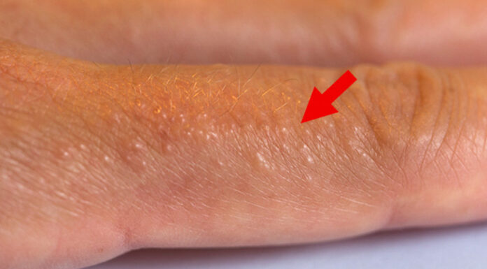If you see these painful red bumps, you may have dyshidrotic eczema